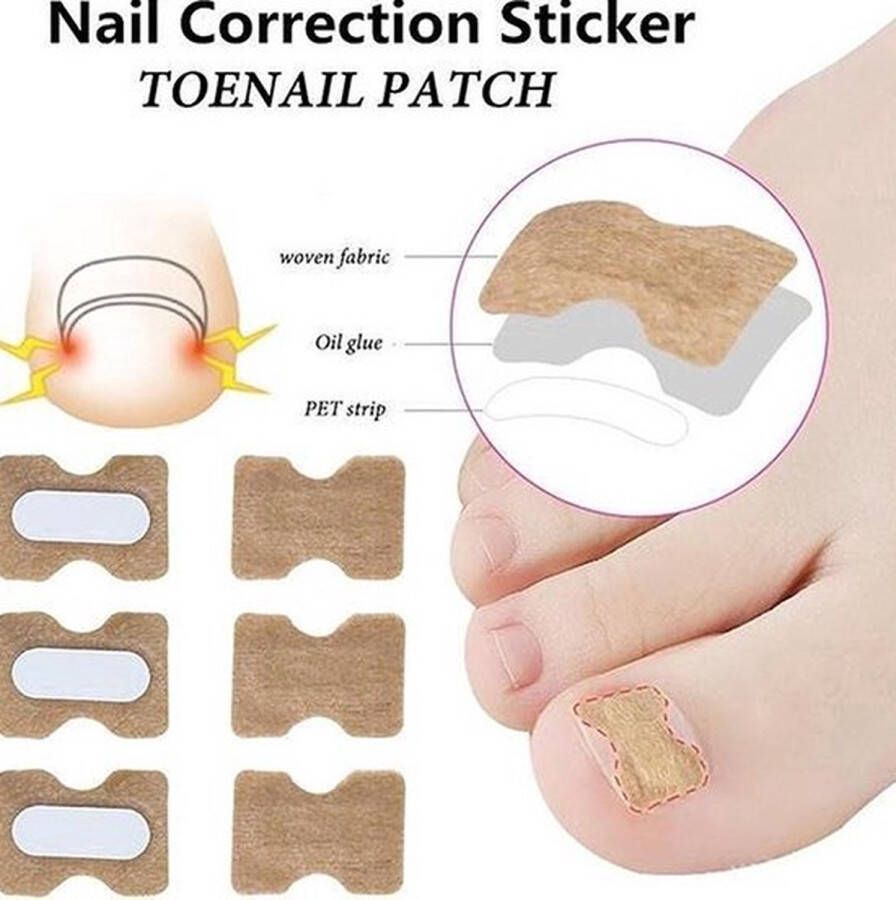 Cheaperito Teennagel Lifter Pleisters 30 Stuk I Ingegroeide Teennagel Corrector I Teennagel I Anti Ingroei Pleister I Nagel Correctie Kit