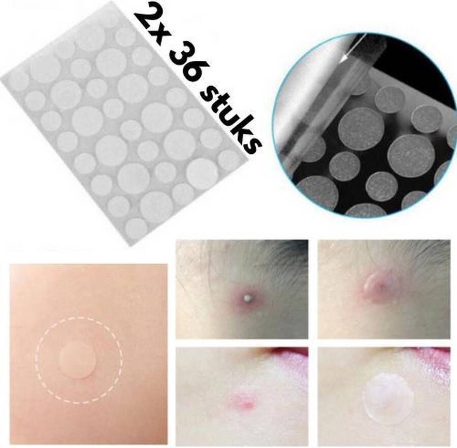 Merkloos Sans marque 72 Stuks Acne Patches | Stickers voor het Verwijderen van Acne Puisten 2x 36 Stuks