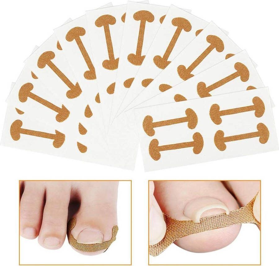 Ingegroeide Teennagel Corrector Stickers Ademend Elastische Teennagel Correctie Patch Teennagelbehandeling Vingernagelverzorging 40 Stuks nagelbeugel