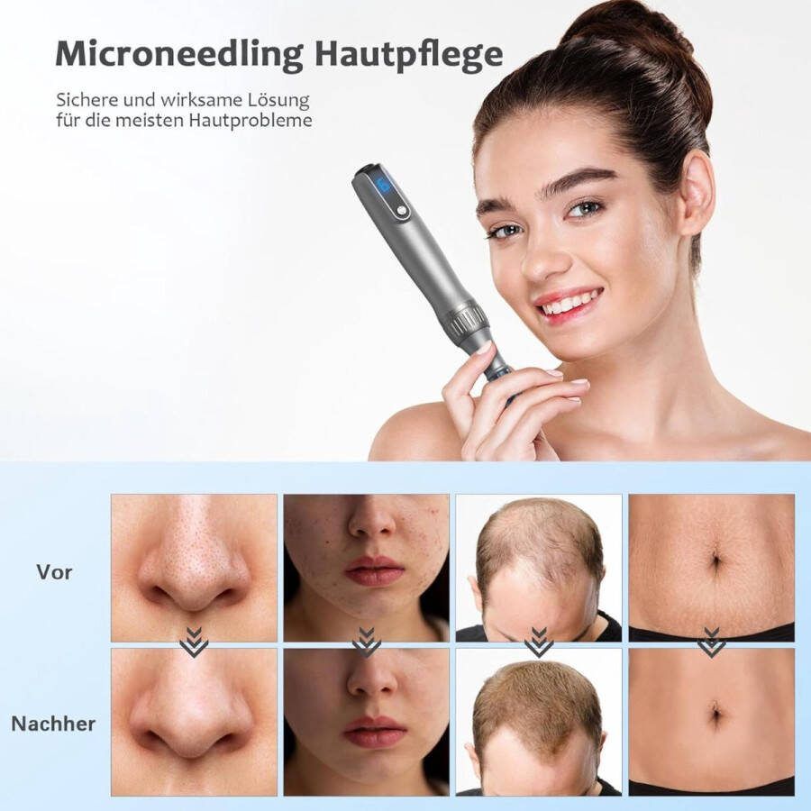 Equivera Laser Plasma Pen Huidverzorging Gezicht Huid Donkere Vlekken Sproeten Pigmentvlekken Wratten Tattoo Moedervlekken Verwijderaar Schoonheid Huidverjonging